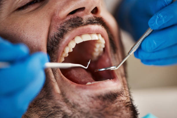 Best Emergency Treatment for Dental Infections or Abscesses in Sanibel, FL